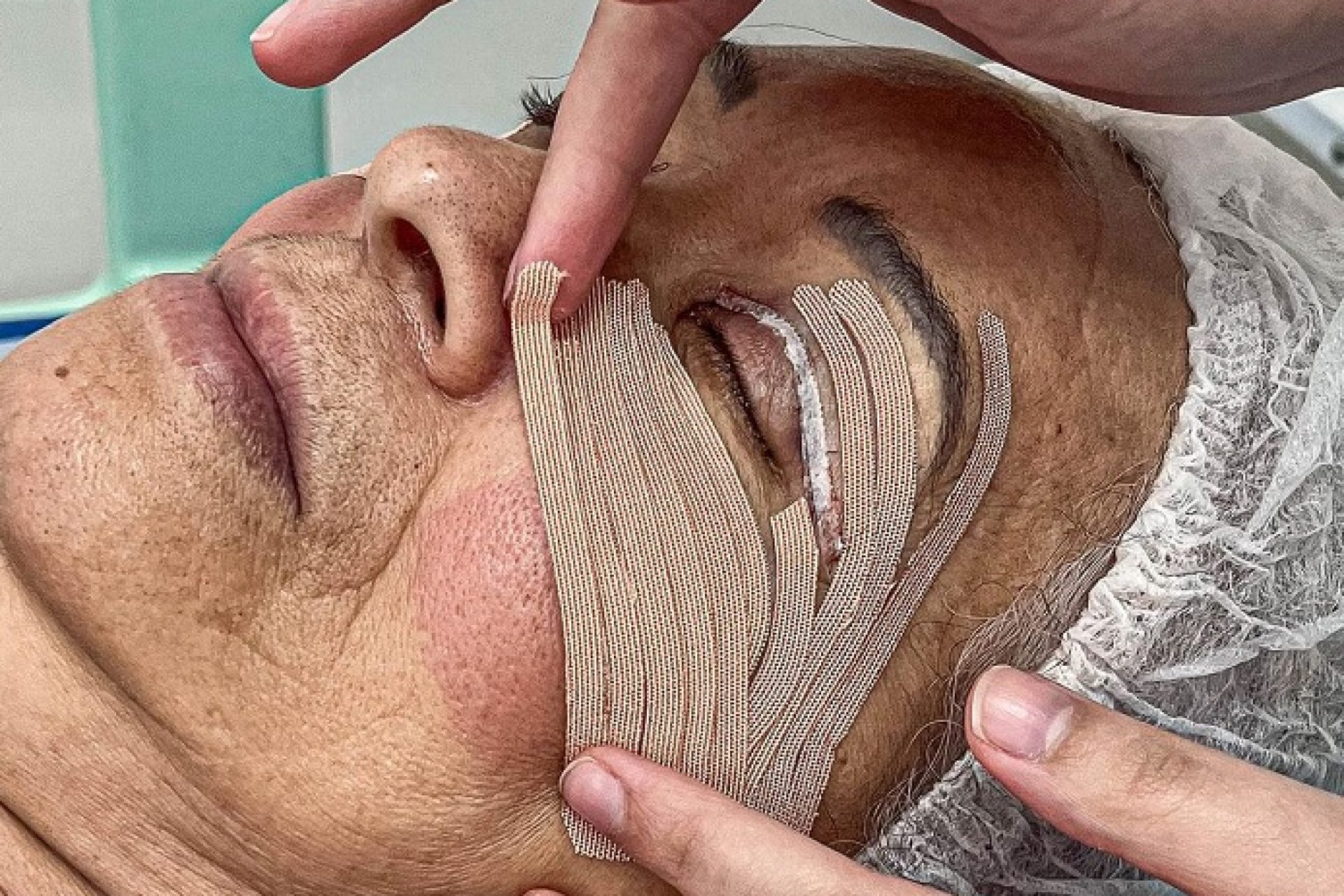 blefaroplastia com cantopexia