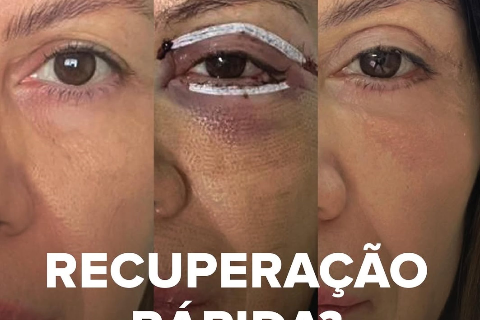 blefaroplastia depois de 15-dias