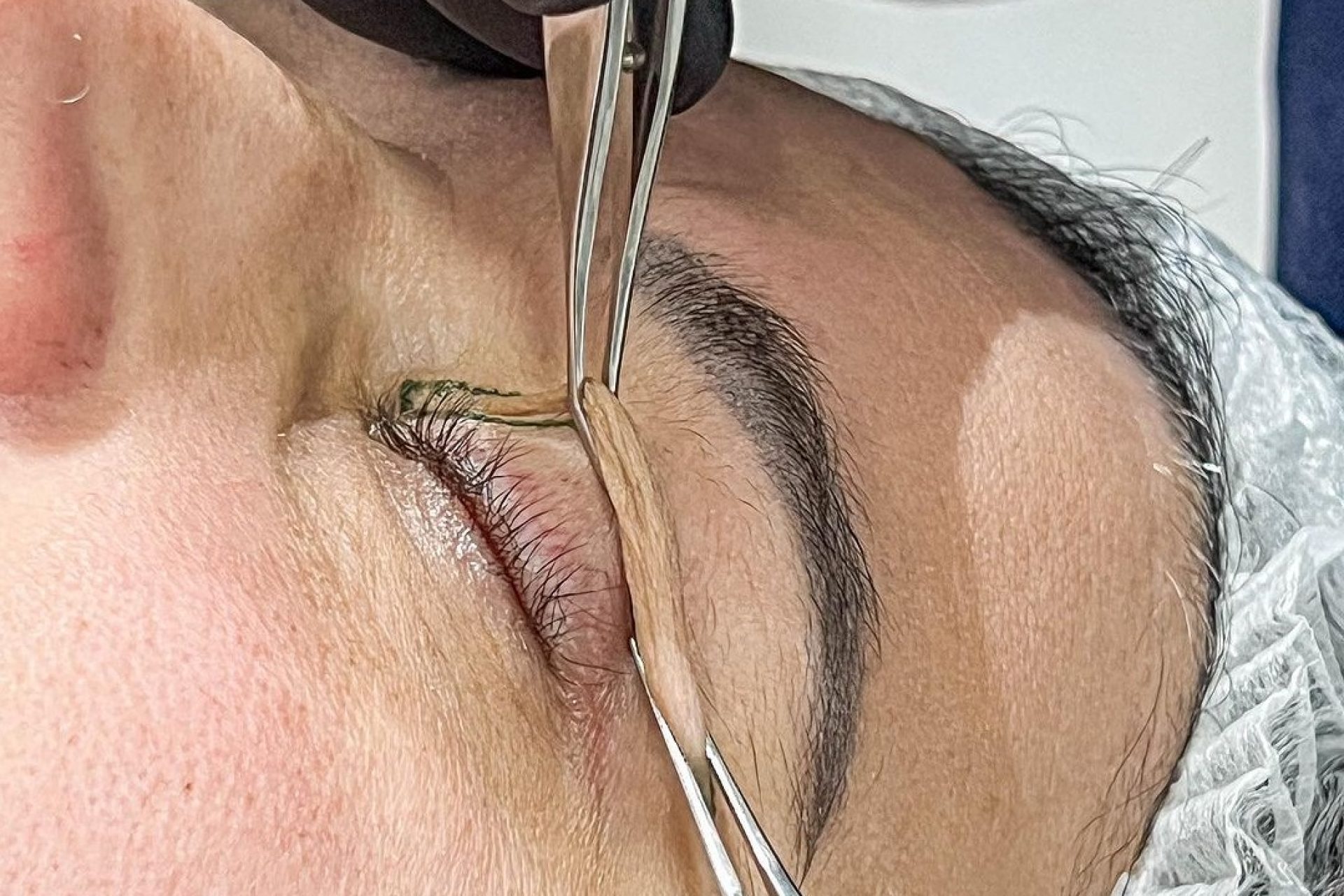 blefaroplastia-guia-completo