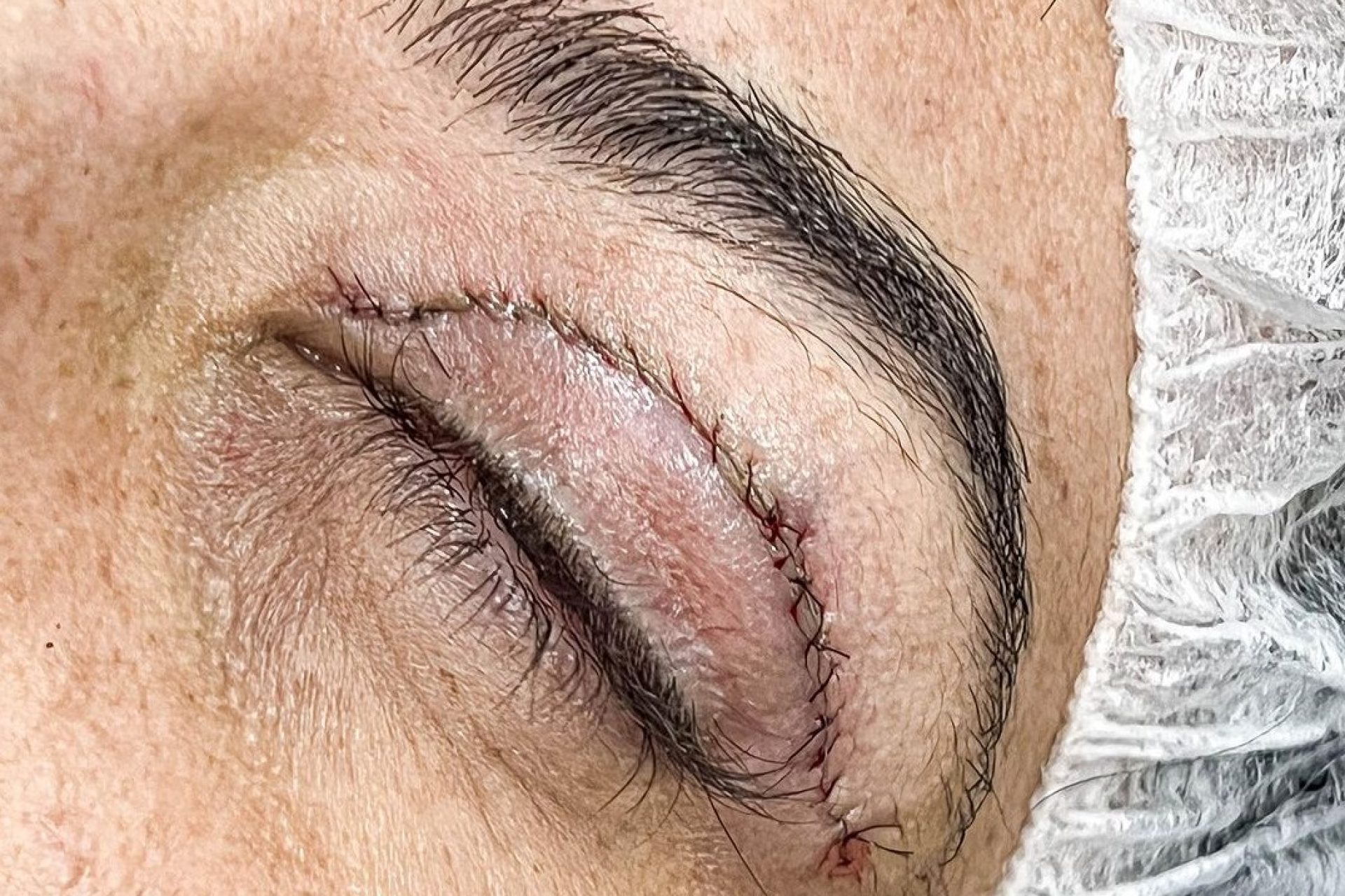 blefaroplastia-superior-01