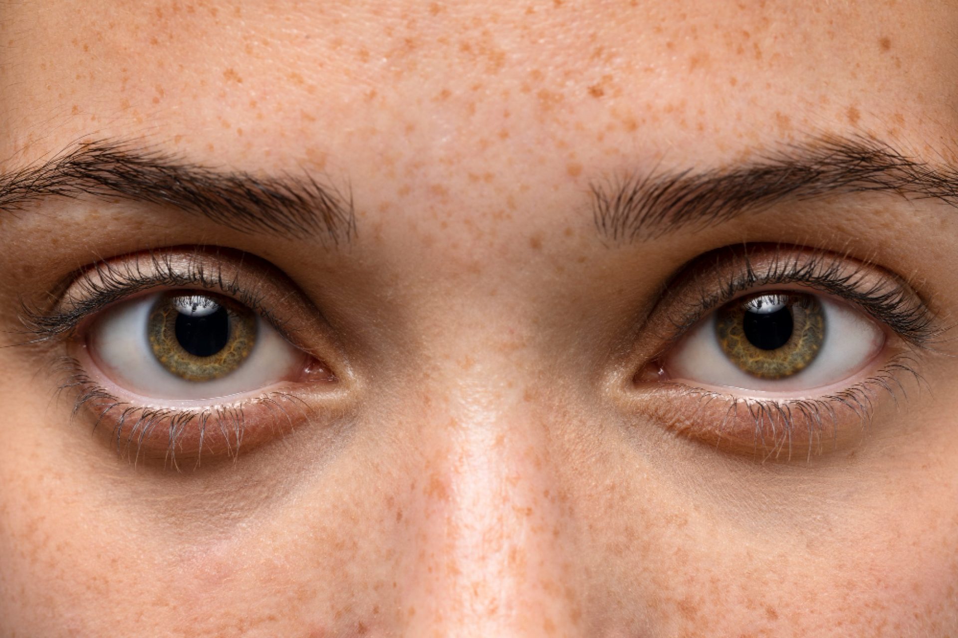 blefaroplastia um olho ficou diferente do outro