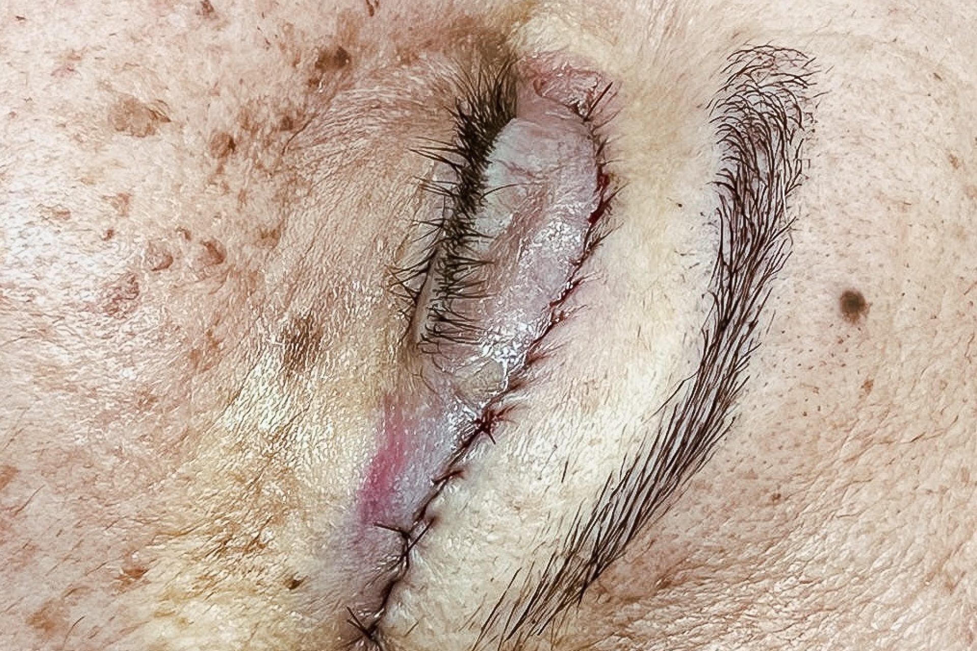 cirurgia-de-blefaroplastia.jpg