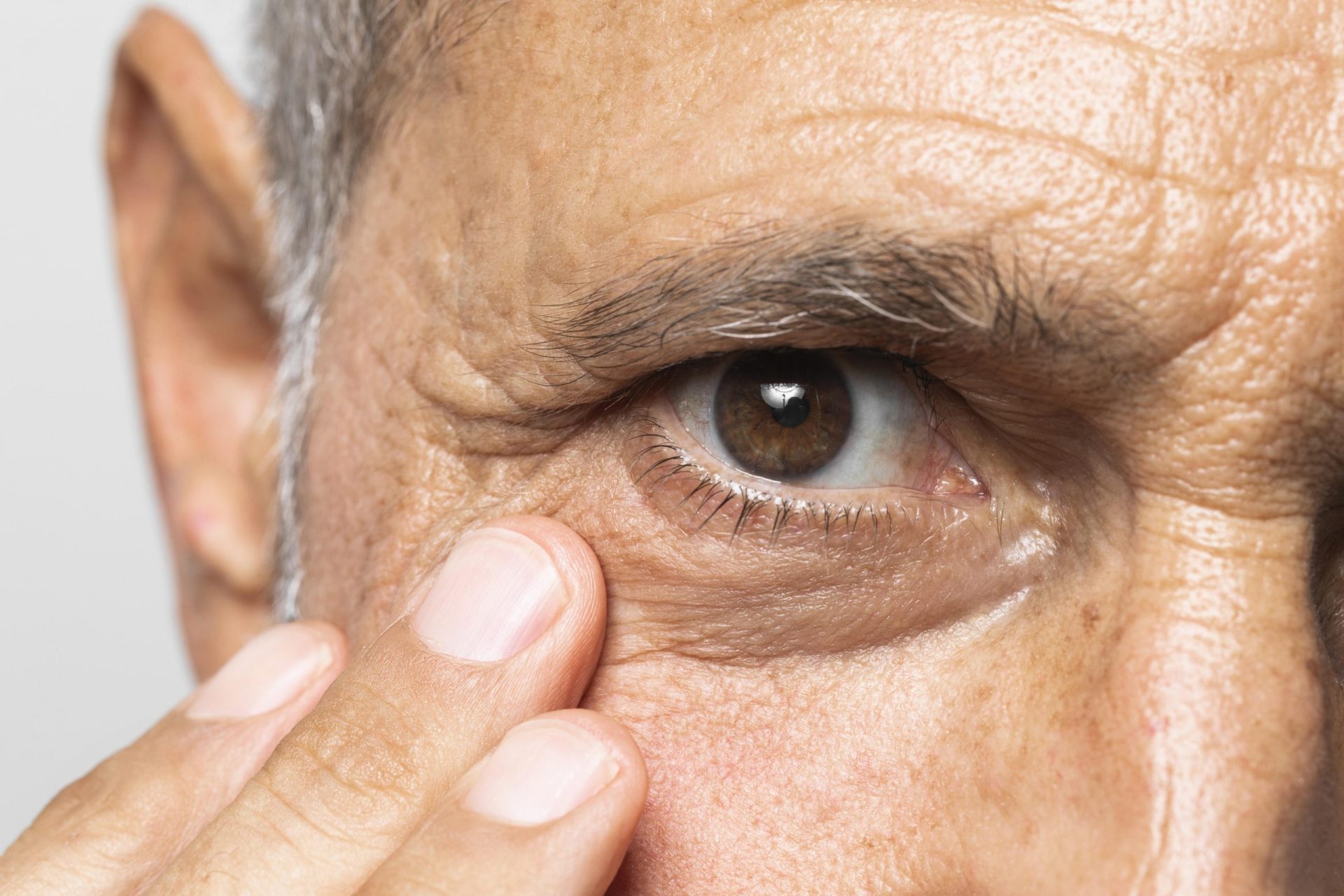 excesso de pele blefaroplastia