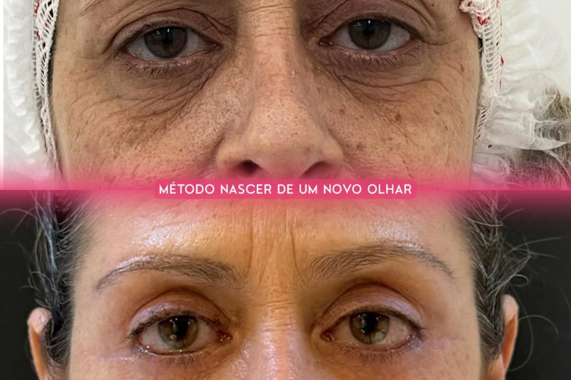 excesso de pele das pálpebras_5