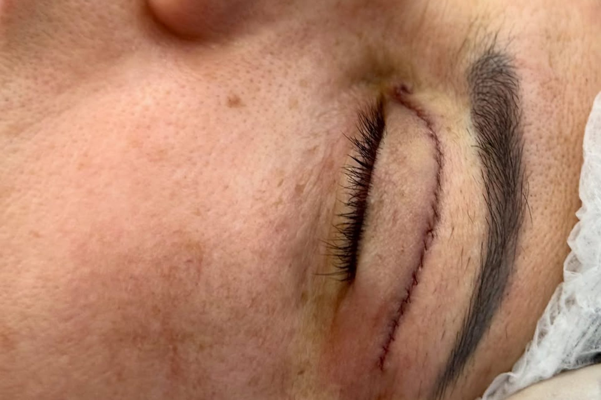 fazer blefaroplastia