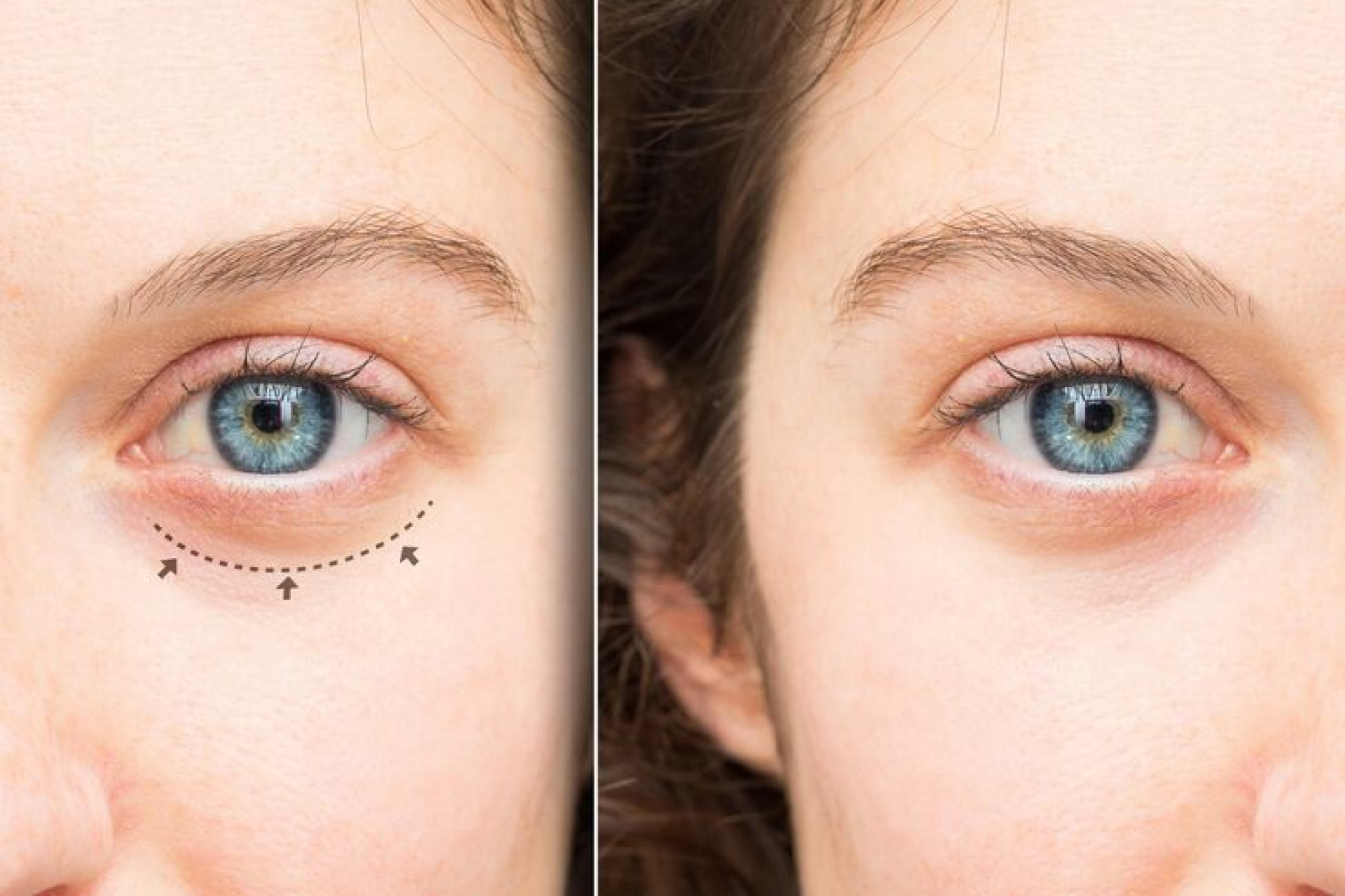 cirurgia de blefaroplastia -Foto: br.freepik.com
