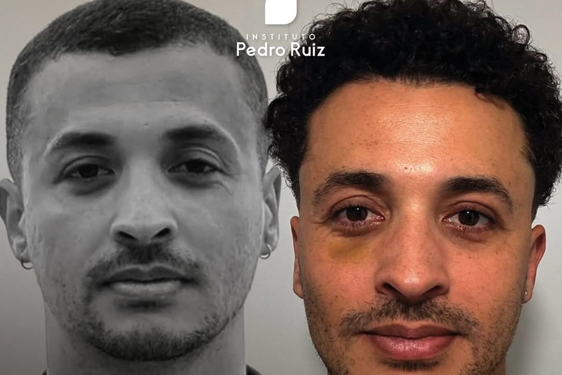 impacto da blefaroplastia