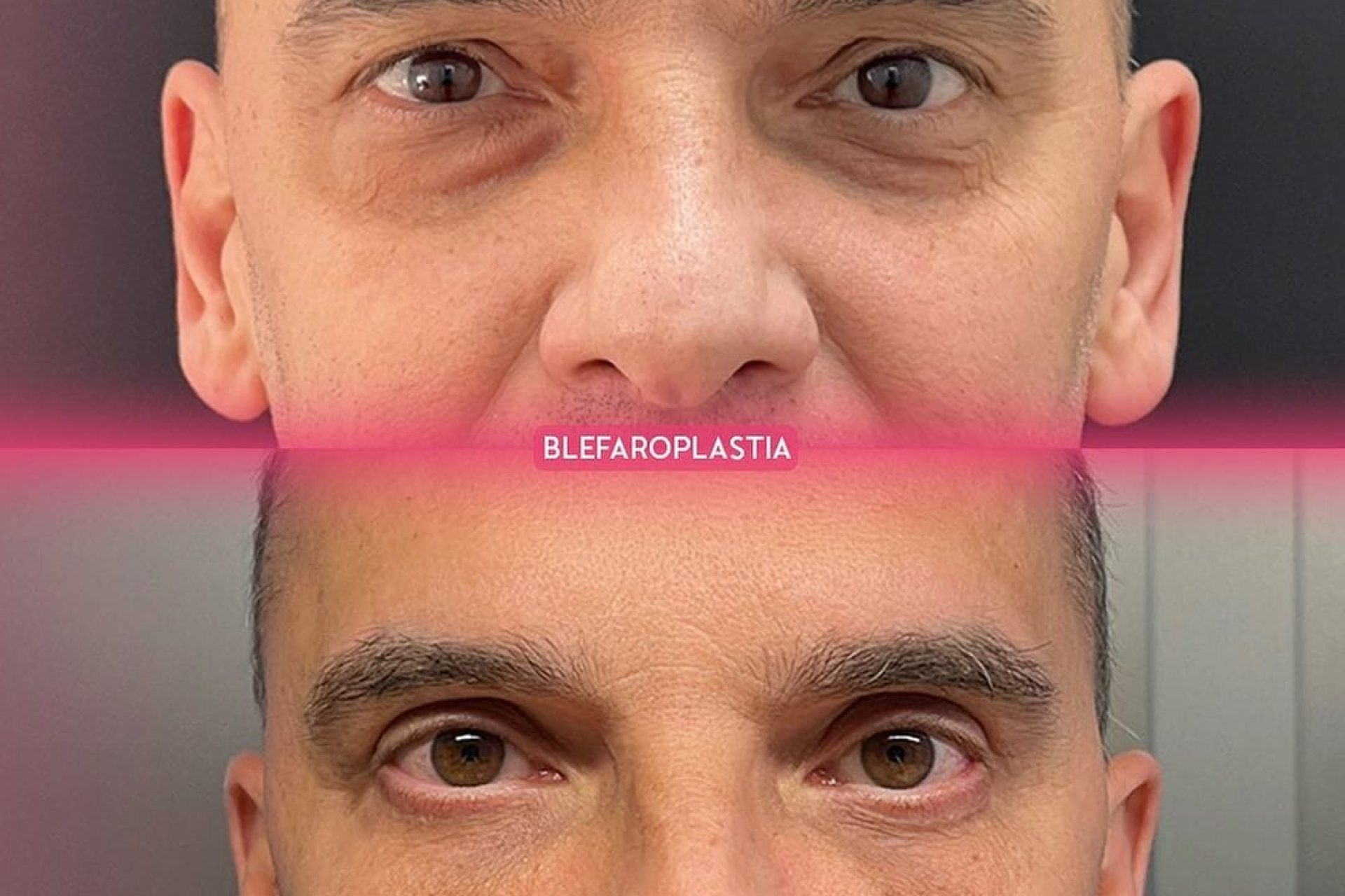 olhar triste BLEFAROPLASTIA