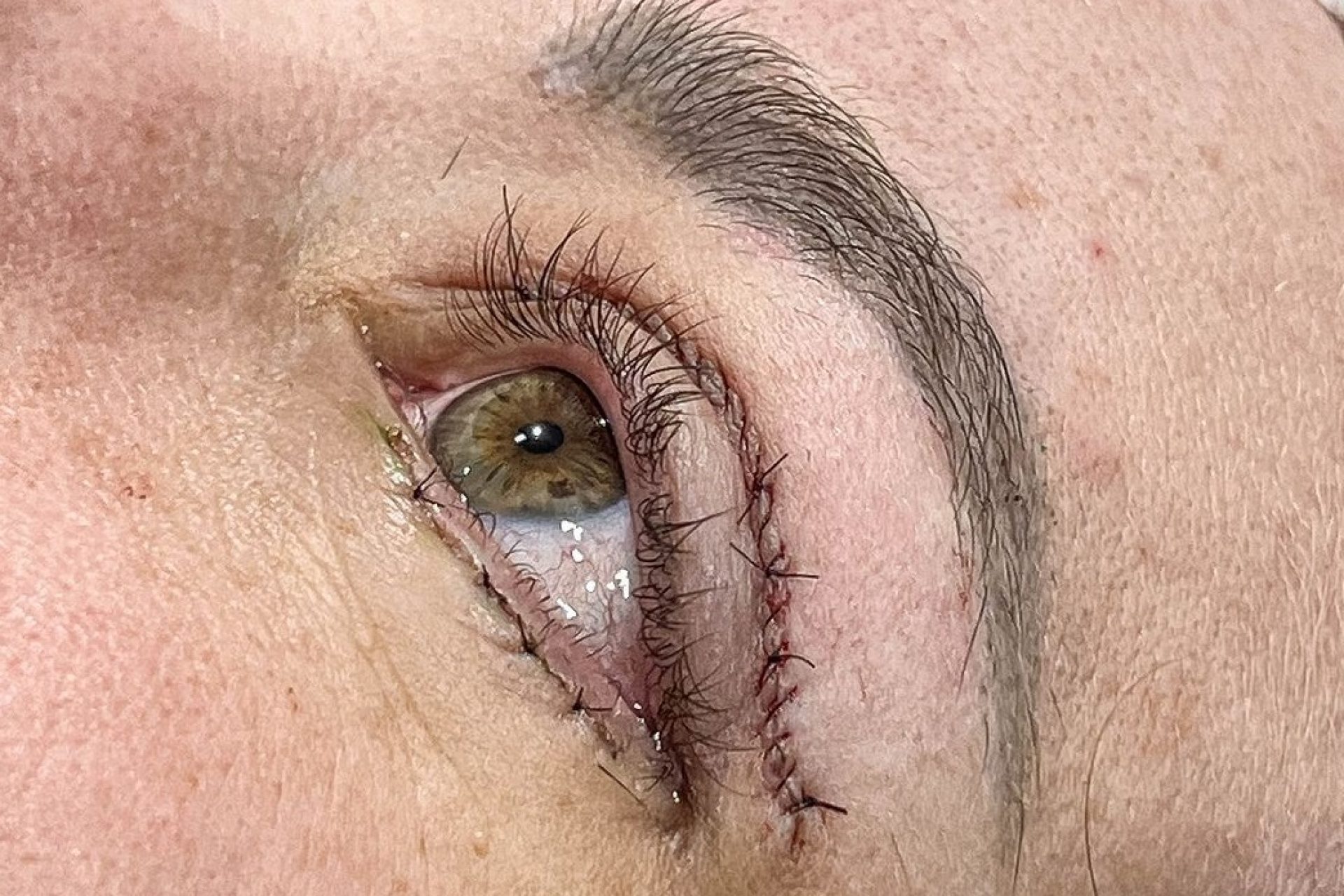 depois-da-blefaroplastia