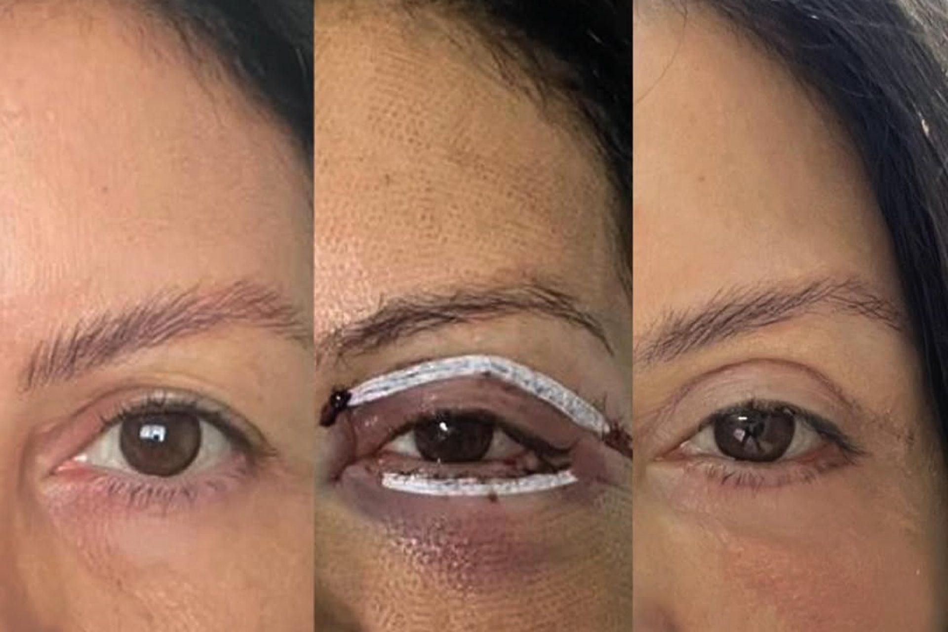olho inchado blefaroplastia