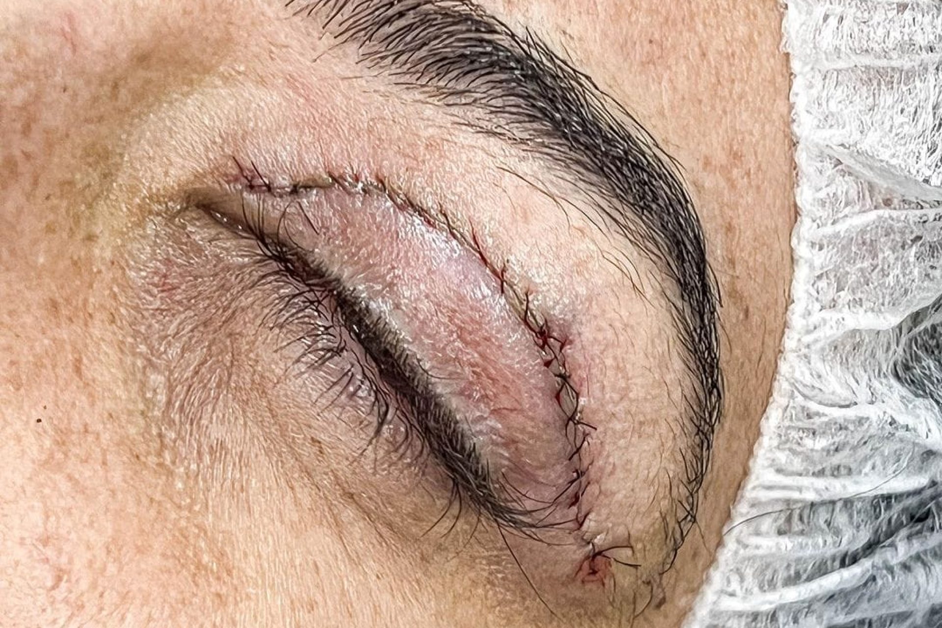 Repouso após blefaroplastia