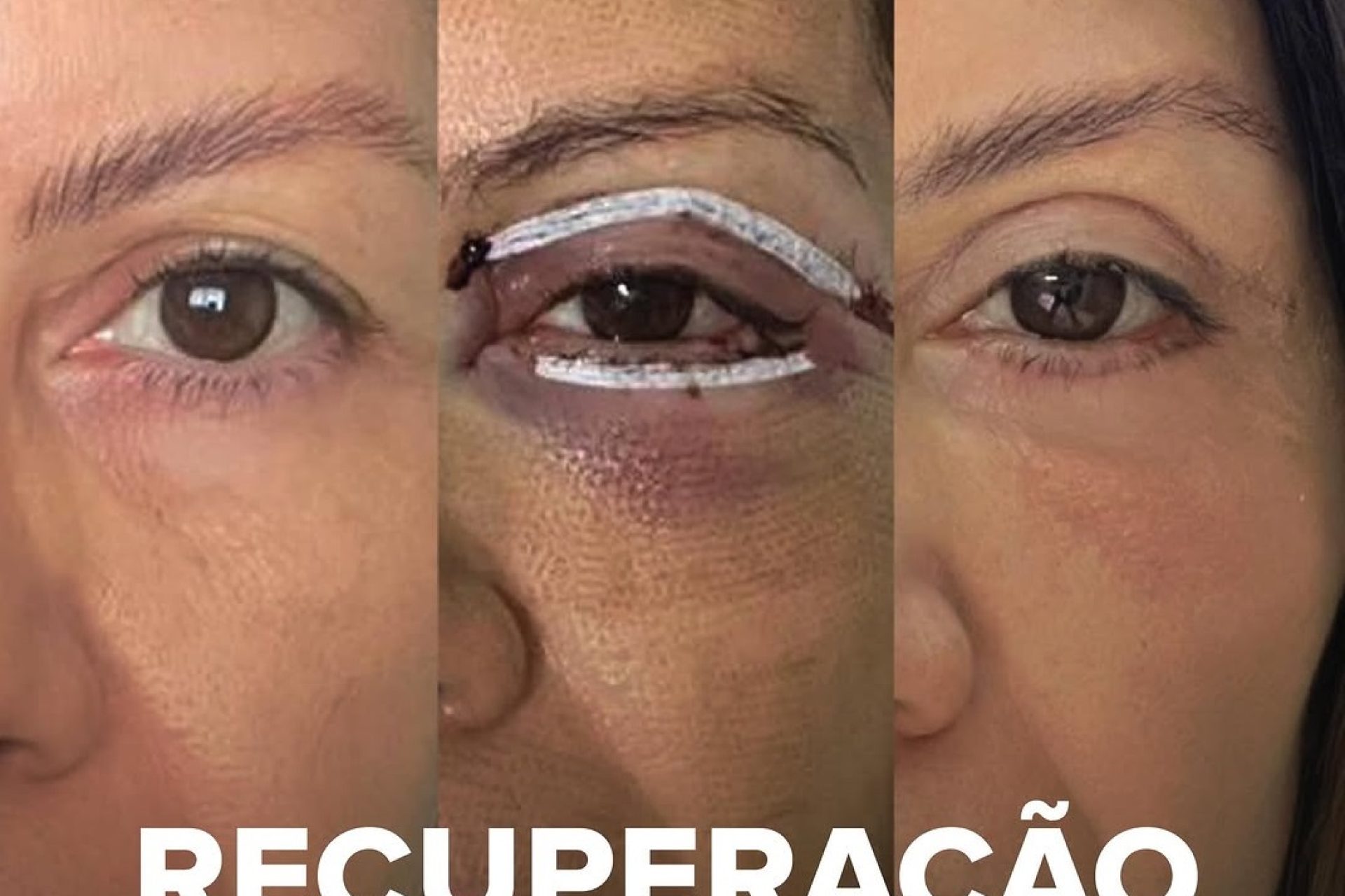 recuperação da blefaroplastia
