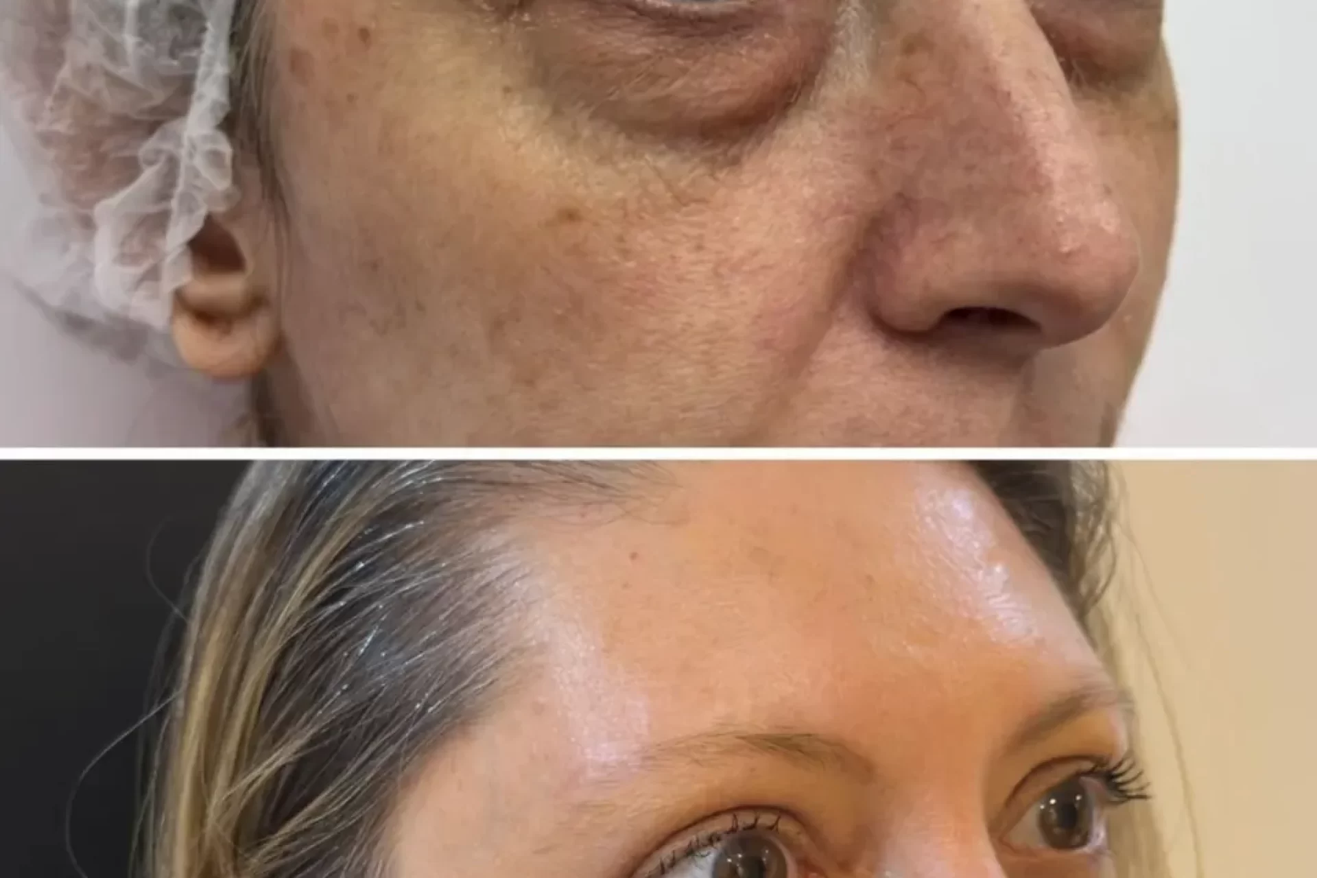 resultado final da blefaroplastia