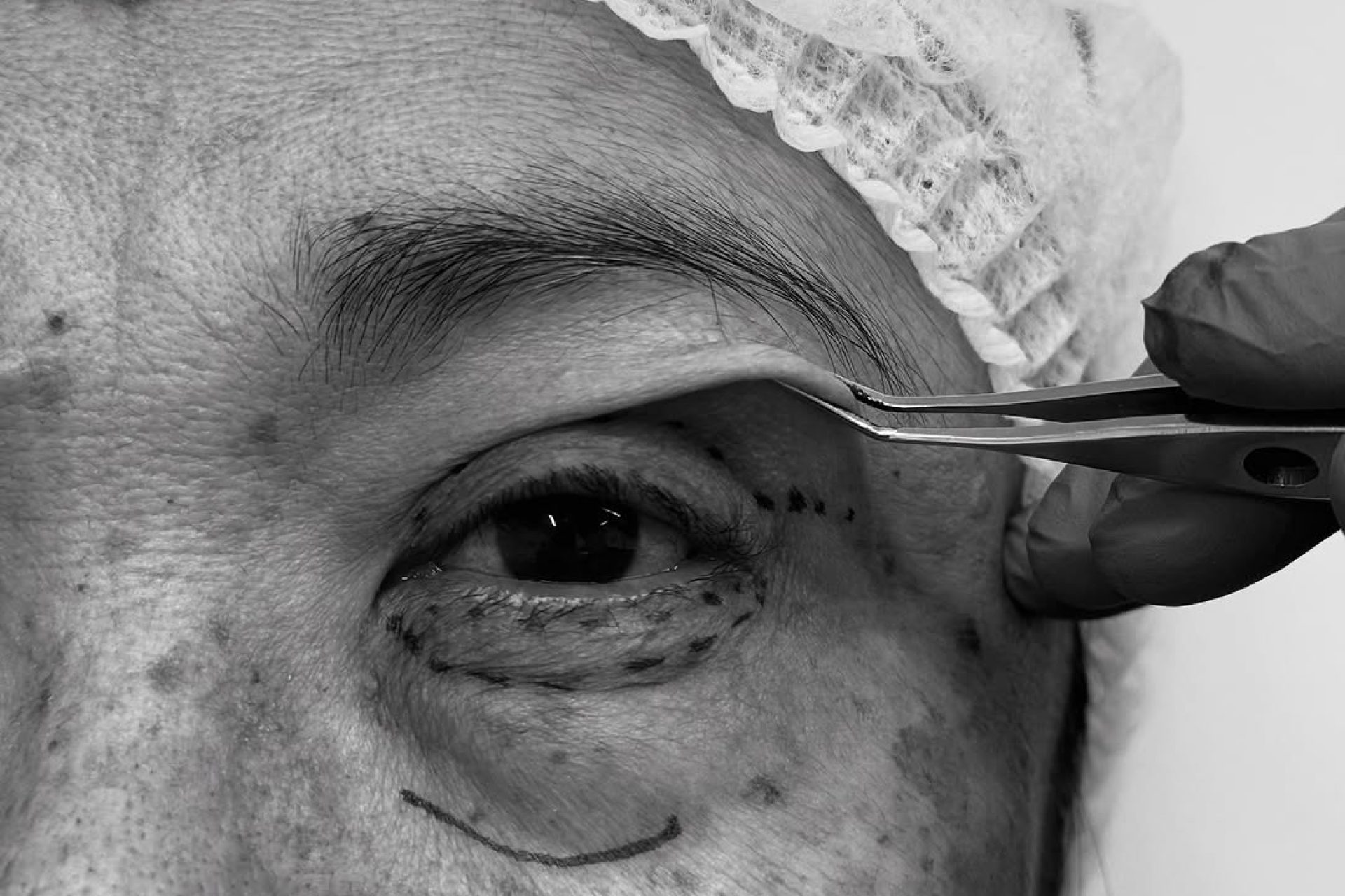 vídeo de cirurgia de pálpebras